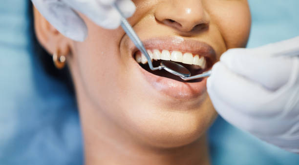 Best Emergency Dental Care for Broken or Chipped Teeth in Hercules, CA