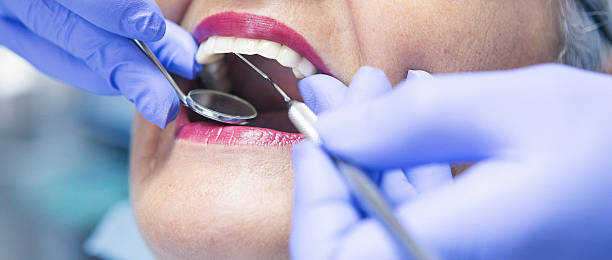 Best Emergency Dental Care for Broken or Chipped Teeth in Hercules, CA